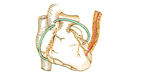 관상동맥 우회수술(Coronary Artery Bypass Grafting) 관련이미지